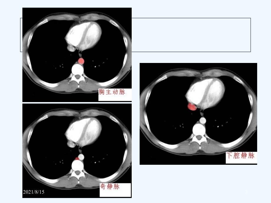 轻松学习腹部CT诊断(PPT159页)_第3页