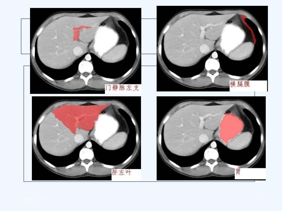 轻松学习腹部CT诊断(PPT159页)_第5页