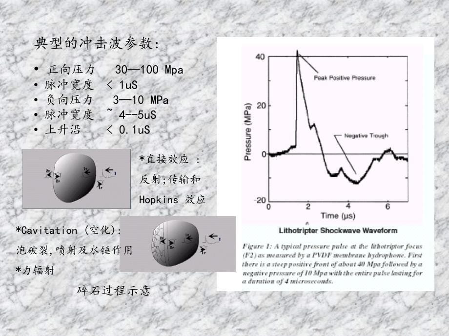 体外冲击波碎石的物理机制及生物效应_第5页