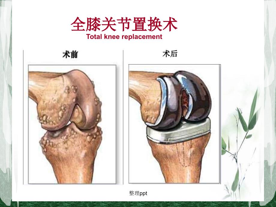 全膝关节置换术后护理PPT_第3页