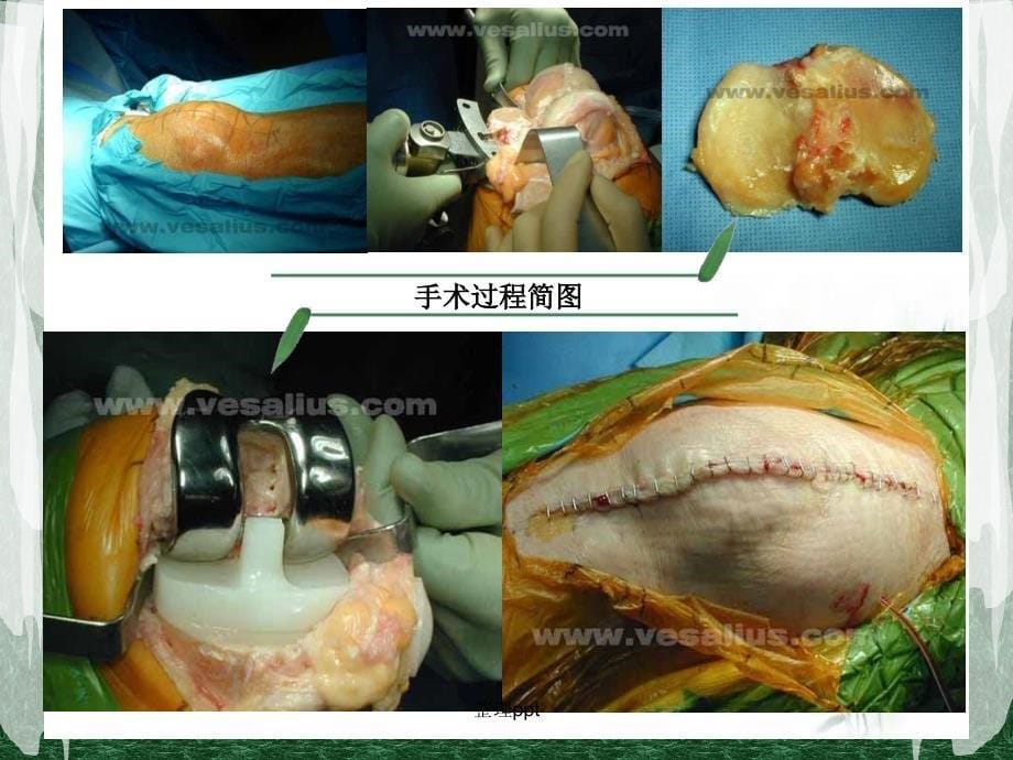 全膝关节置换术后护理PPT_第5页