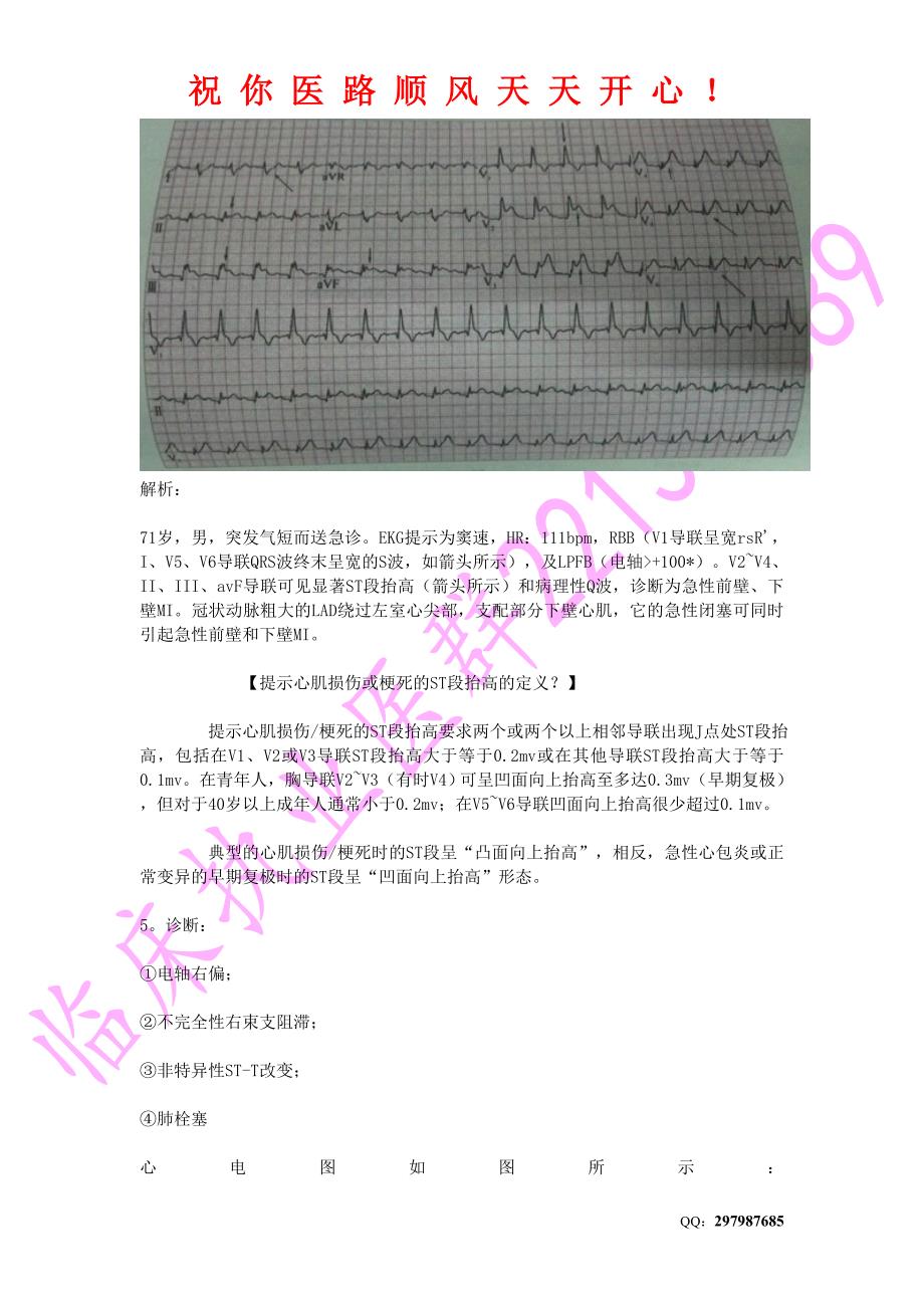 20个心电图解析+记忆技巧 (2).doc_第4页