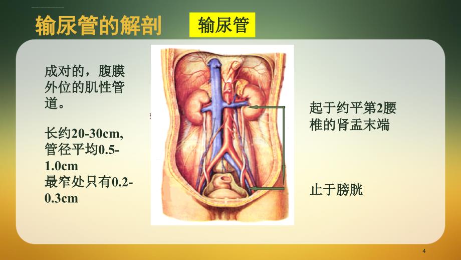 后腹腔镜下输尿管切开取石术ppt课件_第4页