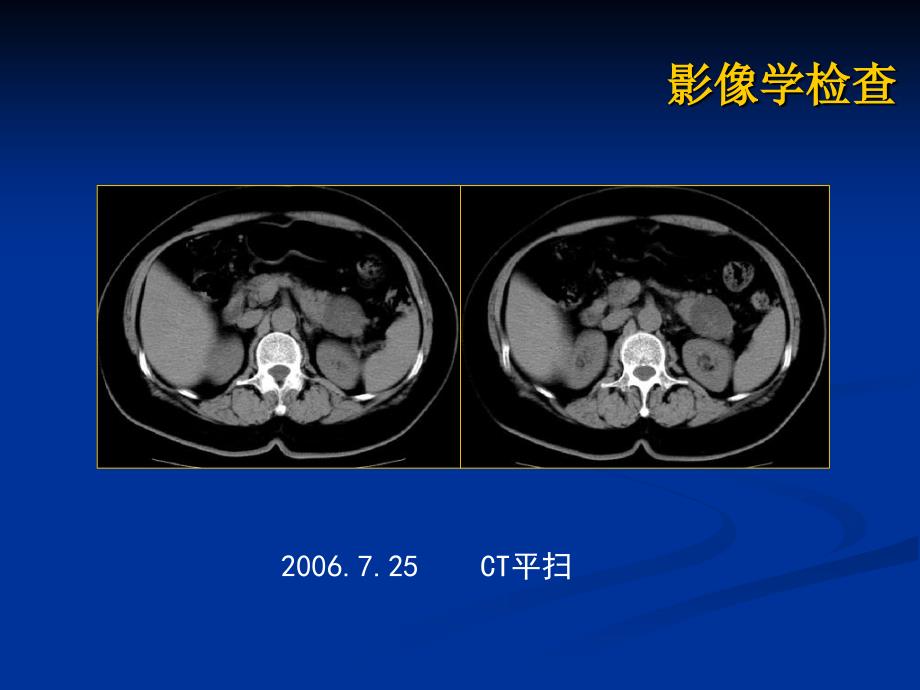 最新胰腺粘液性囊腺瘤病历讨论PPT文档_第3页