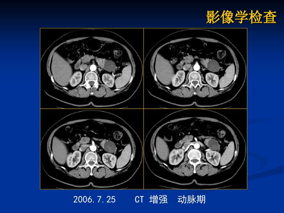 最新胰腺粘液性囊腺瘤病历讨论PPT文档_第4页