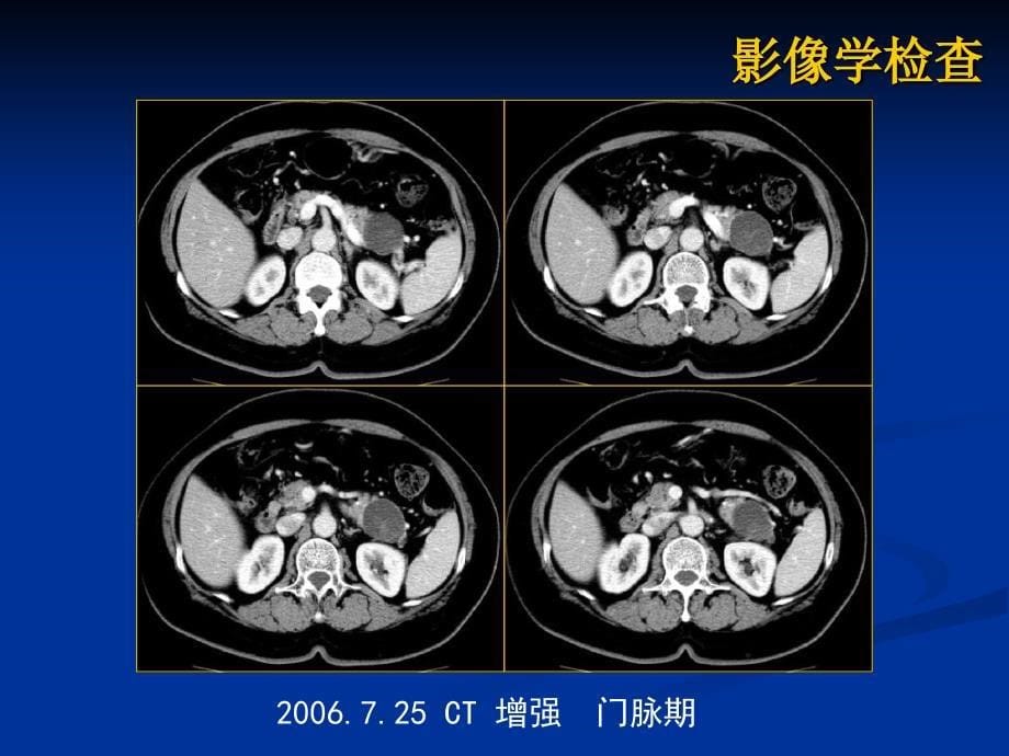 最新胰腺粘液性囊腺瘤病历讨论PPT文档_第5页