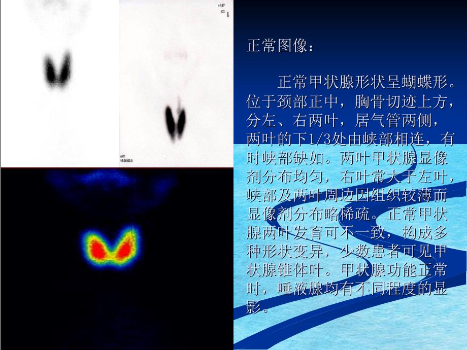 核医学甲状腺功能显像ppt课件_第4页