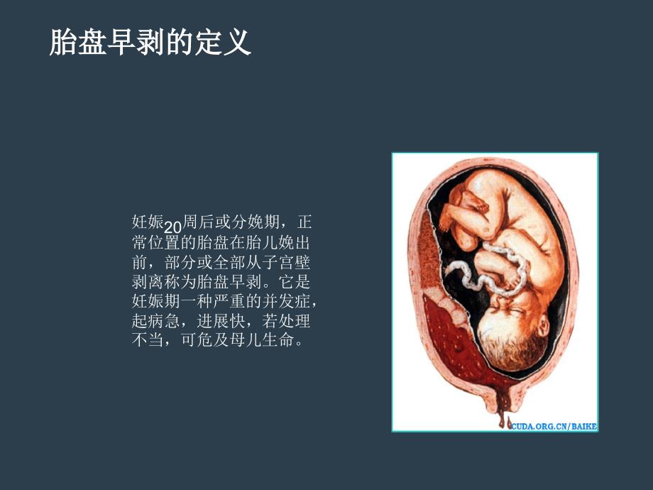 胎盘早剥的护理查房课件_第3页