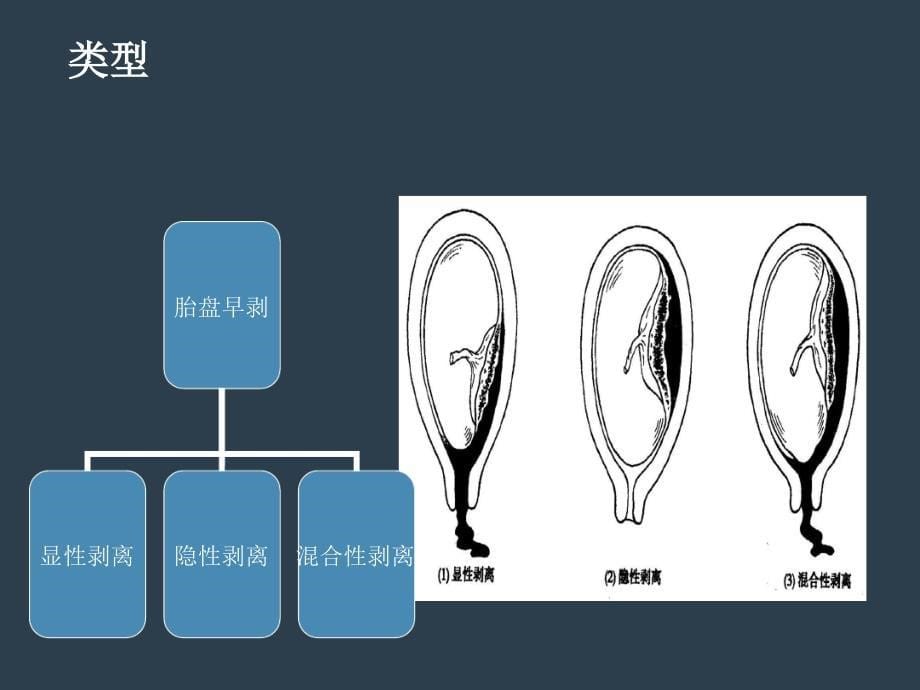 胎盘早剥的护理查房课件_第5页