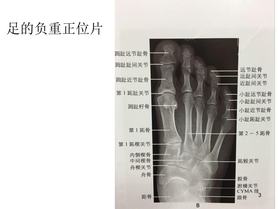 常见足部畸形疾病X线评估PPT参考课件_第3页