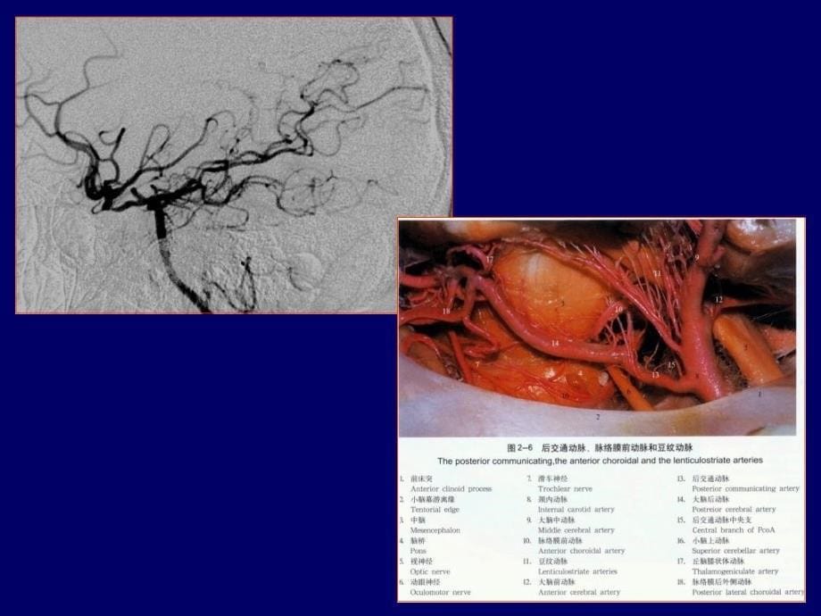丘脑底节区脑血管解剖参考PPT_第5页