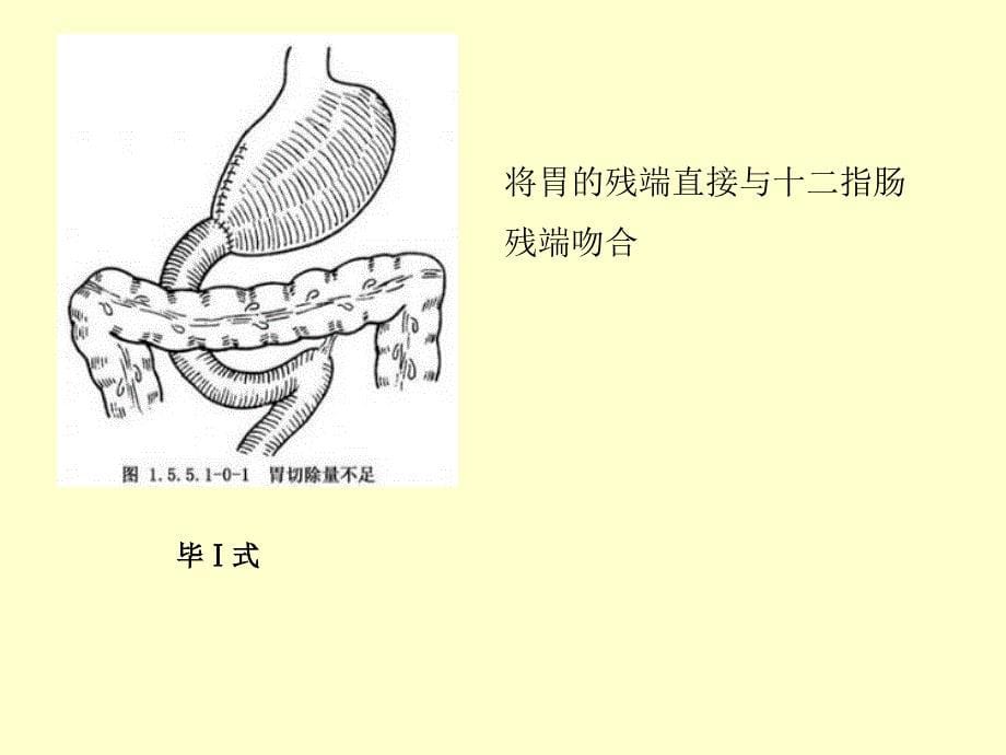 胃癌术后并发症-倾倒综合征_第5页