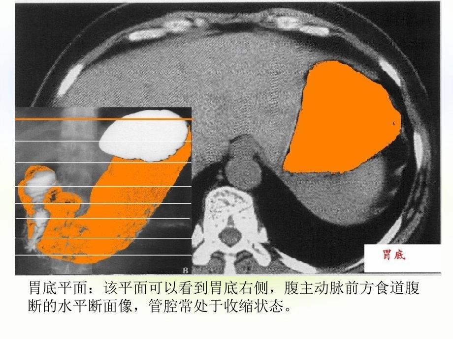 正常腹部CT解剖_第4页