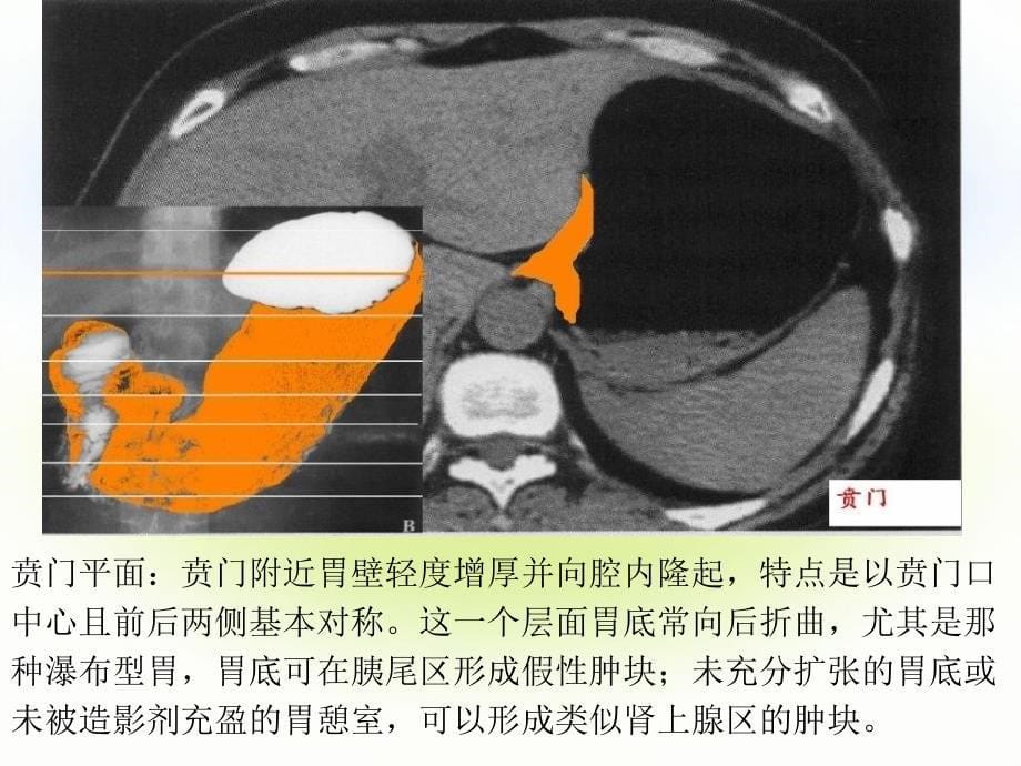 正常腹部CT解剖_第5页