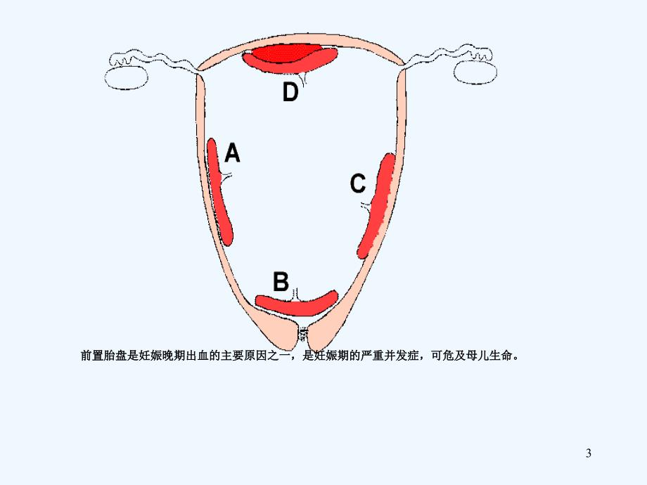 前置胎盘临床诊断与处理指南课件_第3页