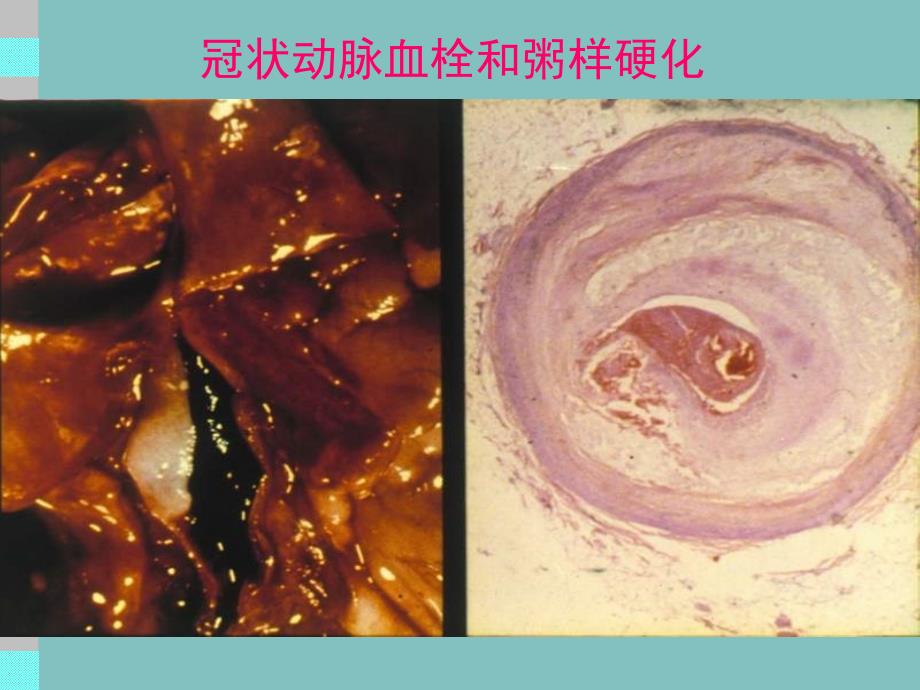 冠状动脉粥样硬化性心脏病CHD课件_第2页