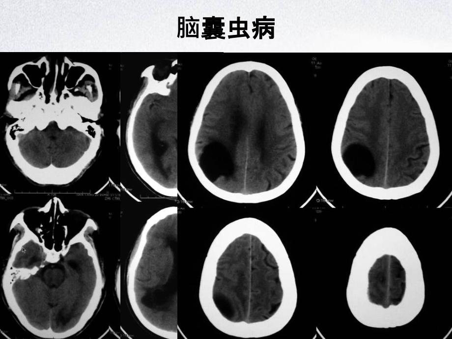 CNS疾病MRI诊断影像集萃三_第3页