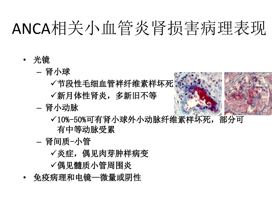 ANCA相关性血管炎肾损害病理表现_第4页