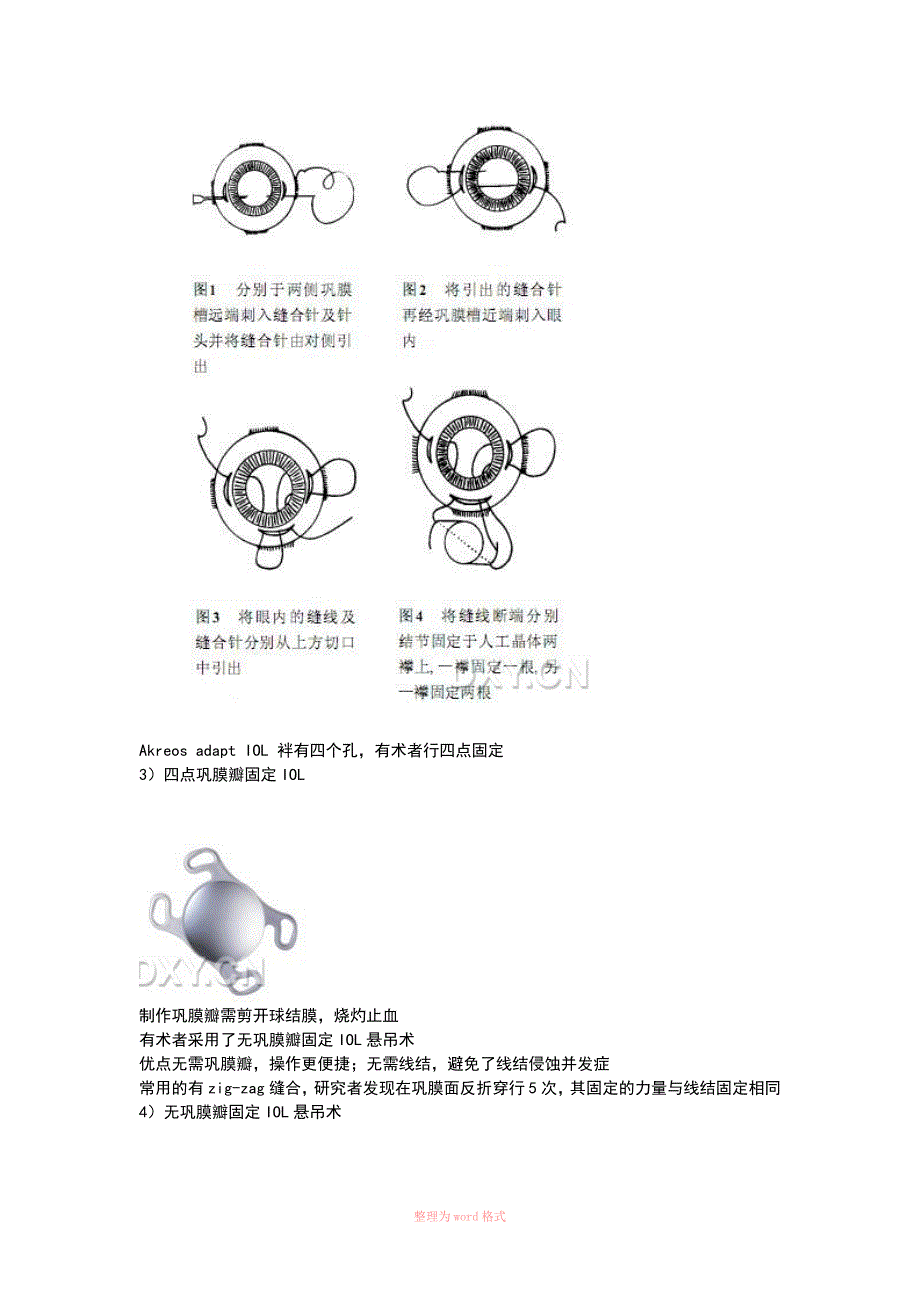 人工晶状体悬吊固定术_第2页