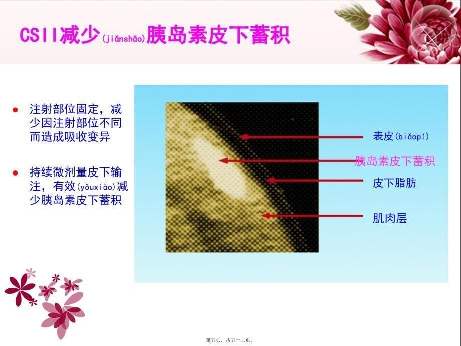 医学专题—胰岛素泵的使用33928_第5页