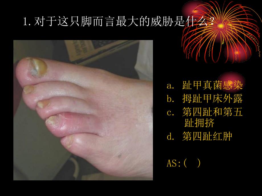 糖尿病足病看图诊断_第3页