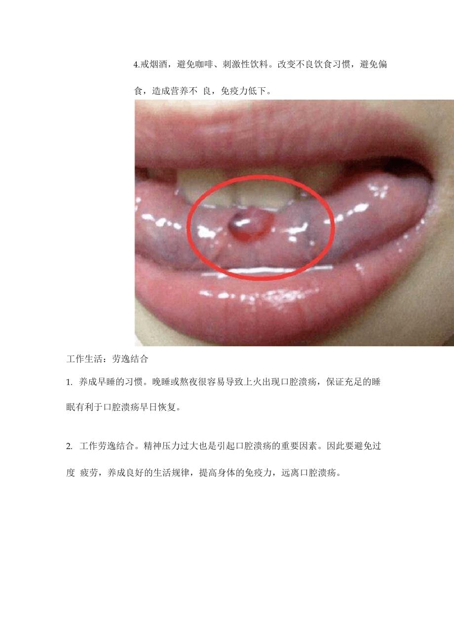 复发性口腔溃疡很煎熬根治方法有一个可试_第4页