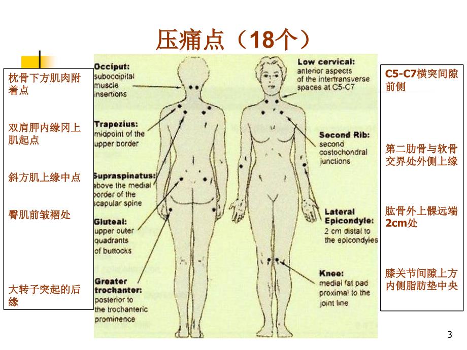 纤维肌痛综合征ppt课件_第3页