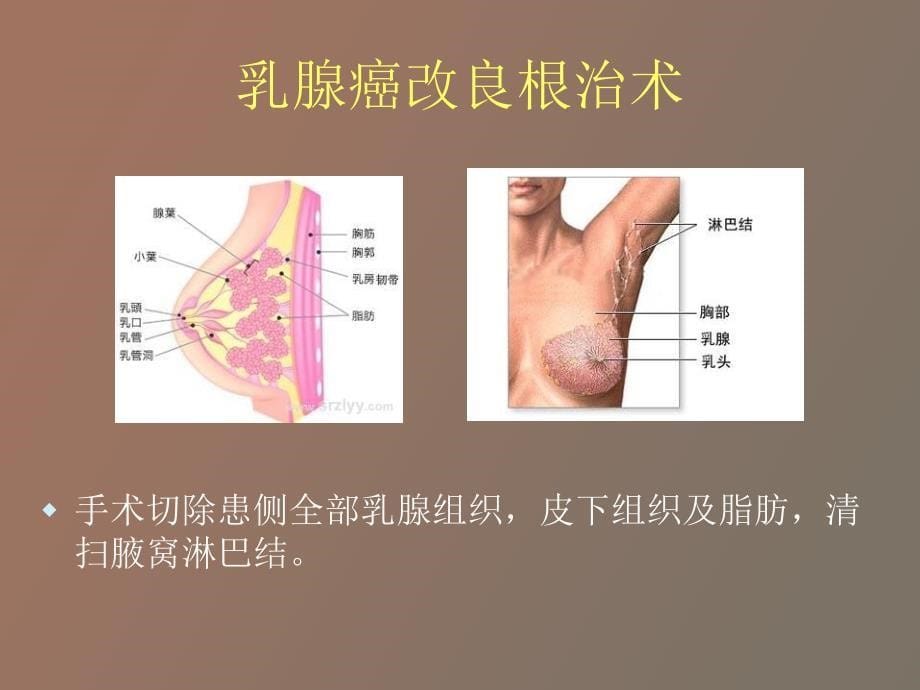 乳癌患者术后患肢功能康复_第5页