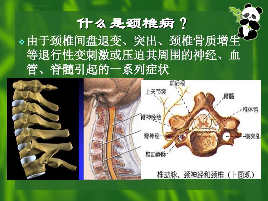 颈椎病的原理和各种治疗方法ppt课件_第3页