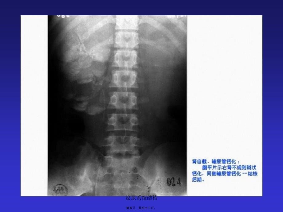 泌尿系统结核课件_第5页