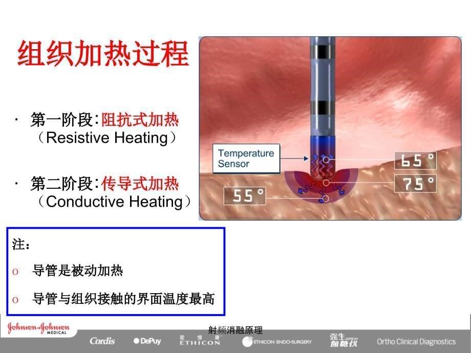 射频消融原理课件_第5页