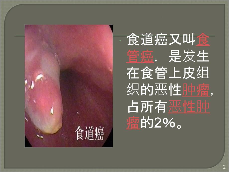 食道癌ppt课件_第2页