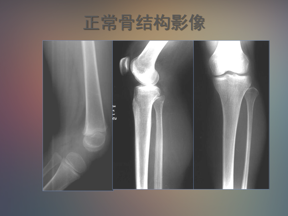 骨肿瘤及肿瘤样病变影像学诊断_第2页