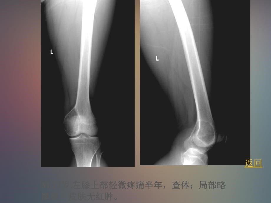 骨肿瘤及肿瘤样病变影像学诊断_第5页