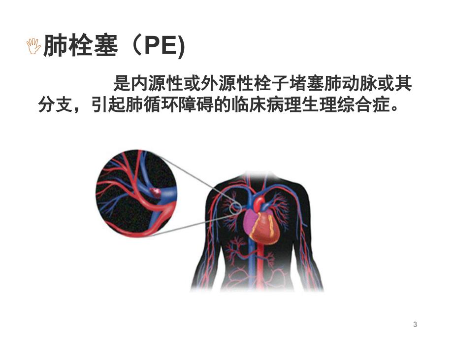 肺栓塞患者的护理课件_第3页