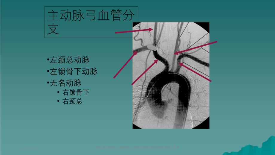 颈部血管超声正常解剖及常见病的超声诊断标准_第4页