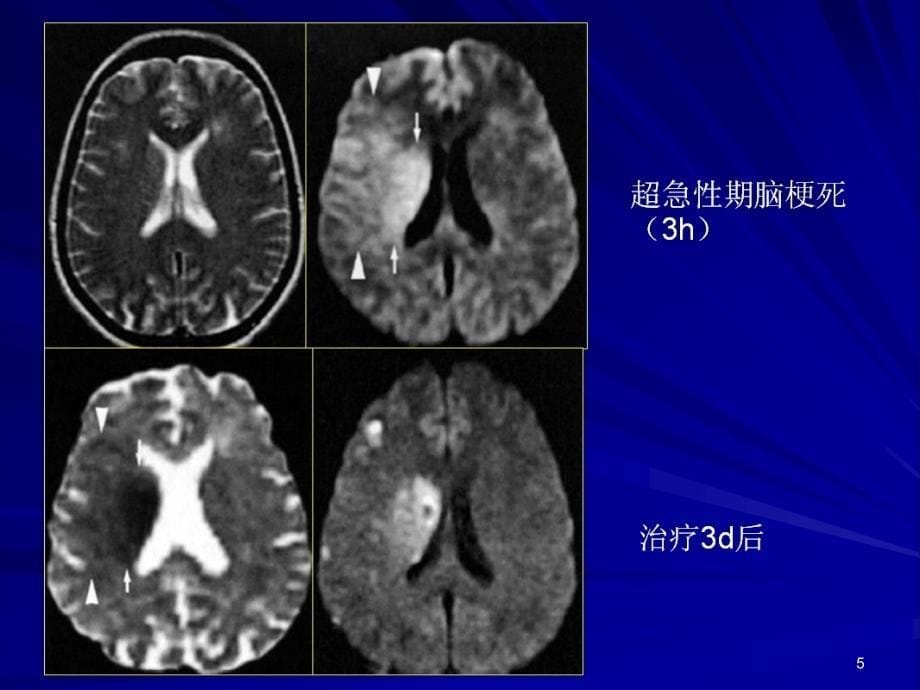 DWI临床应用ppt课件_第5页