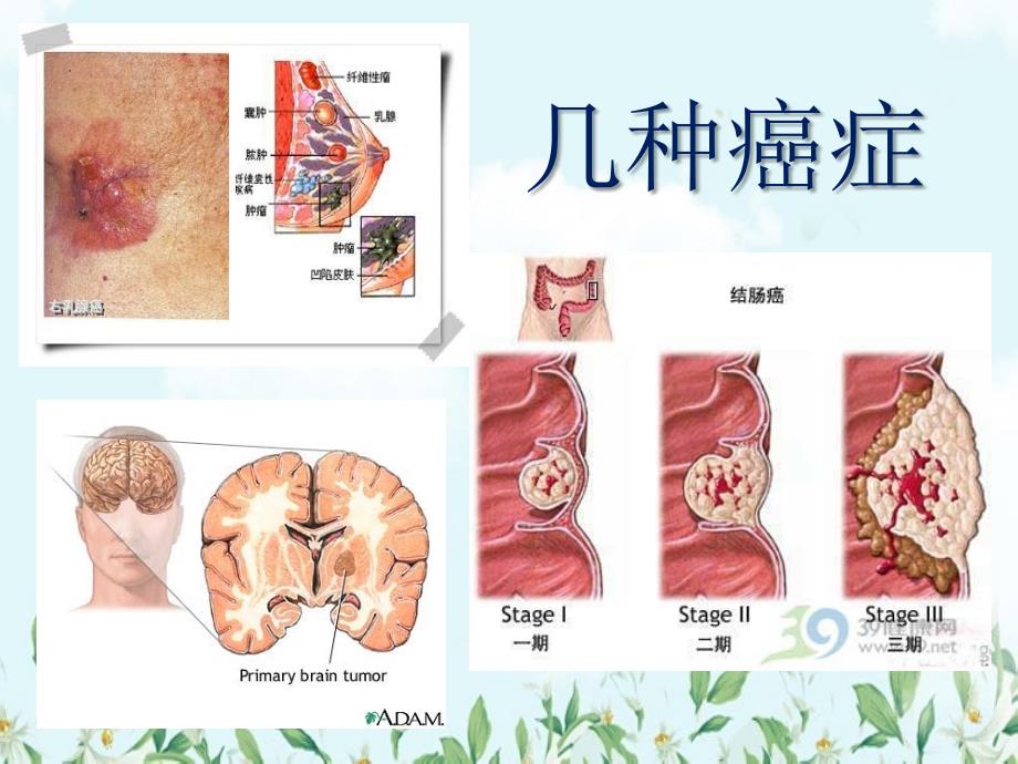 高中生物必修一6.4细胞的癌变_第3页