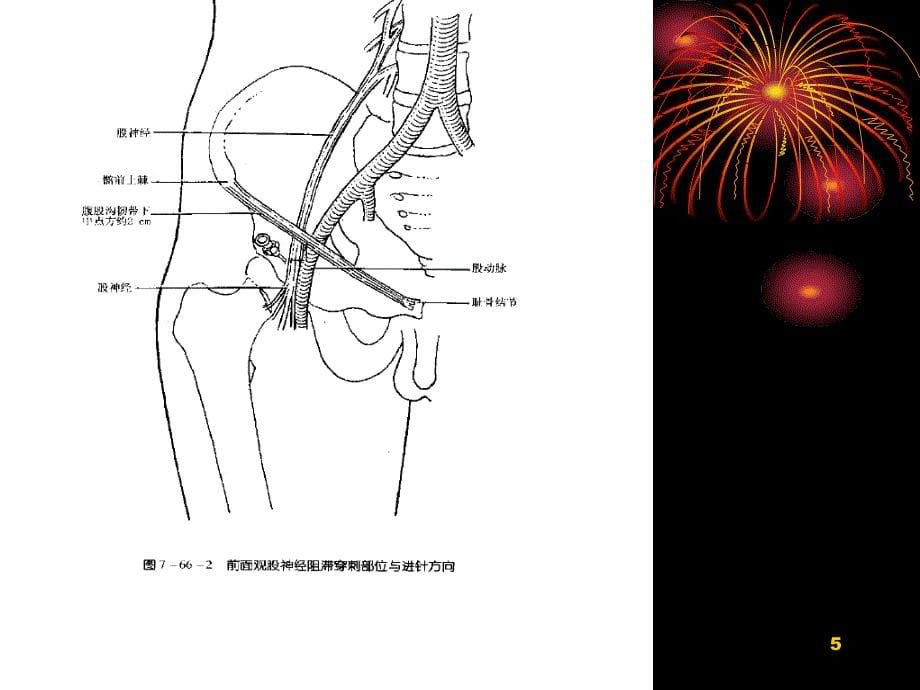 股神经阻滞麻醉PPT参考幻灯片_第5页