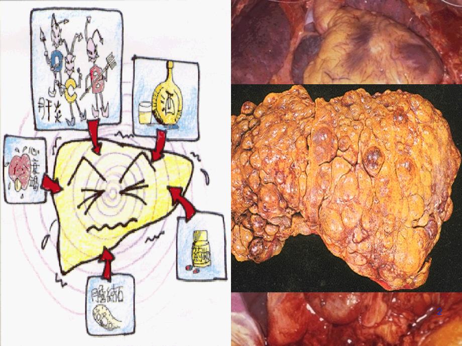 病理学肝硬化ppt课件_第2页
