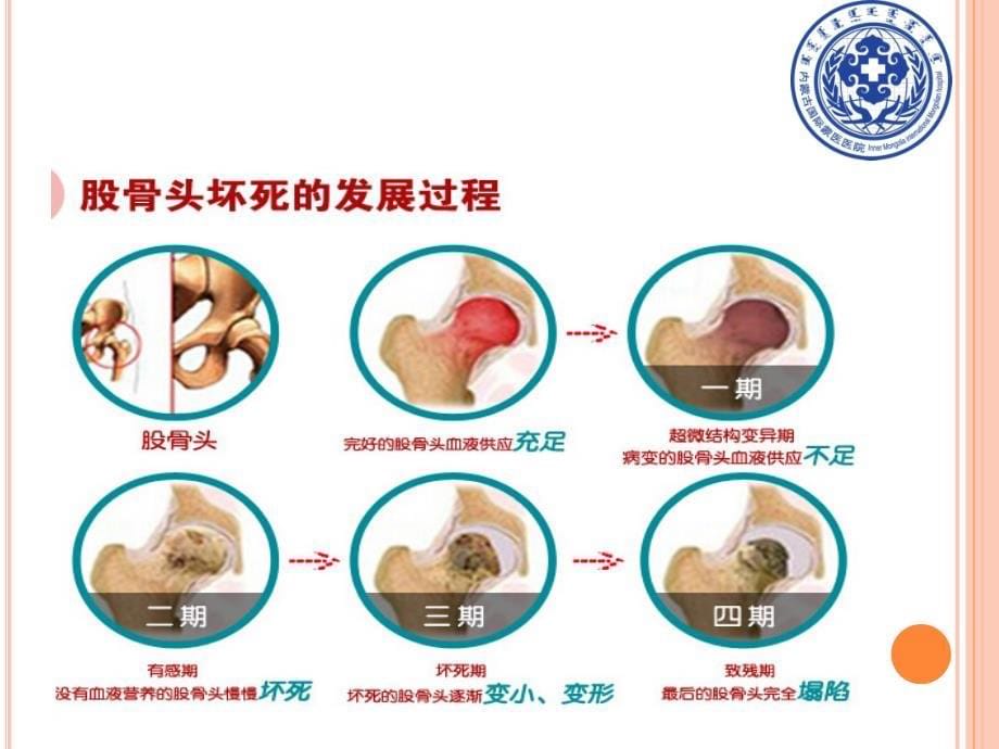 髋关节置换术后护理查房副本课件_第5页