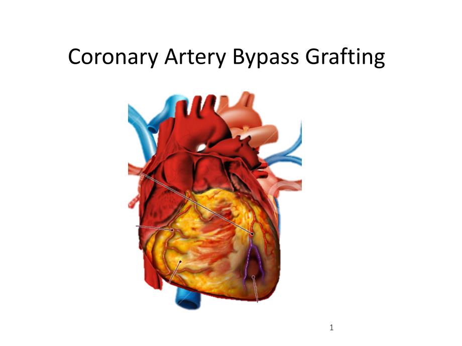 冠状动脉搭桥术CABGPPT课件_第1页