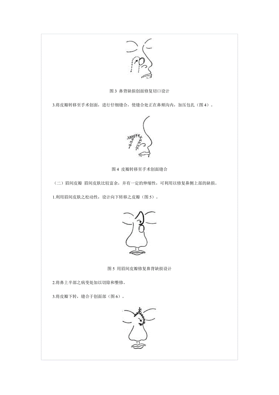 用邻近皮瓣整复鼻背、鼻尖、鼻梁缺损术.doc_第3页