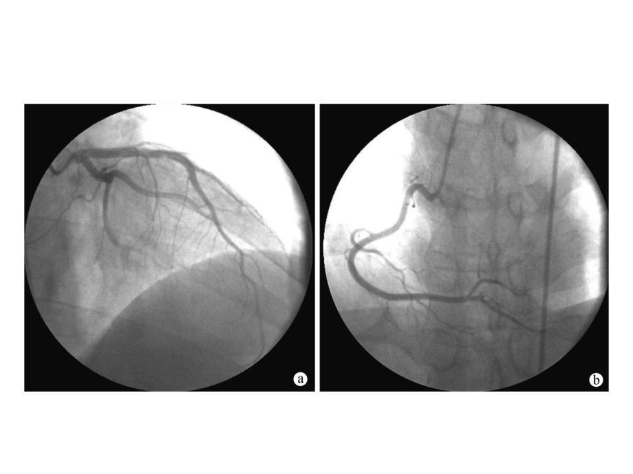 STEMI心电图识别和急诊PCI-医学资料_第4页