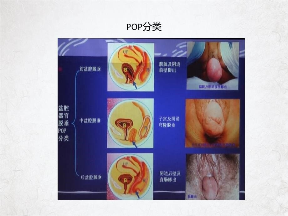 盆底超声科内诊断标准PPT课件_第5页