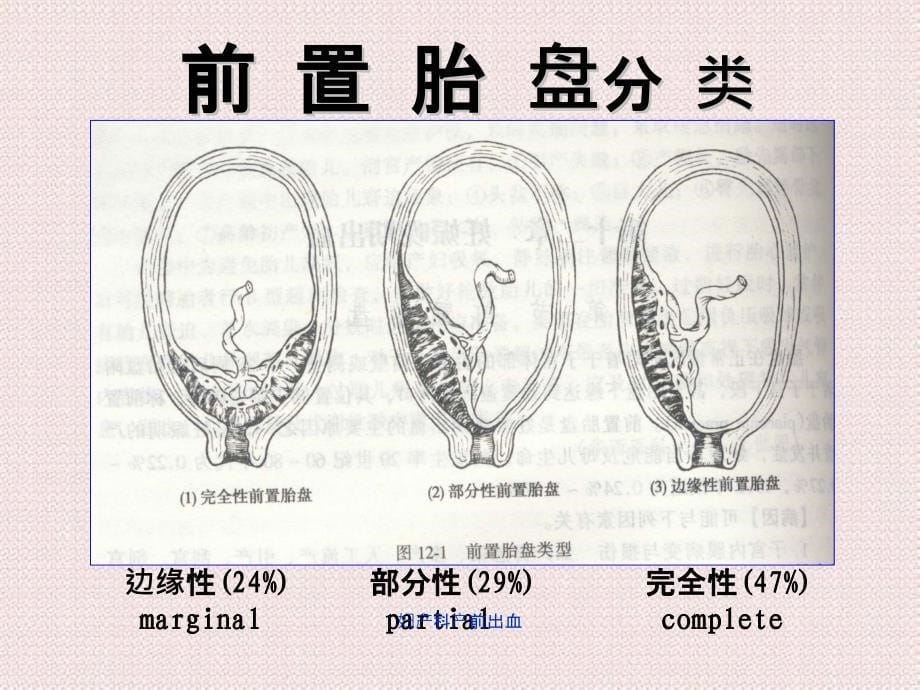 妇产科产前出血_第5页