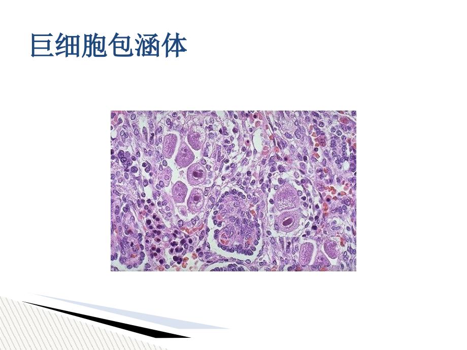 儿童巨细胞病毒性疾病诊断和防治_第3页