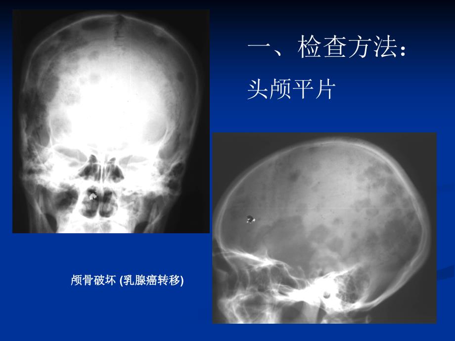 颅脑影像神内ppt课件_第3页