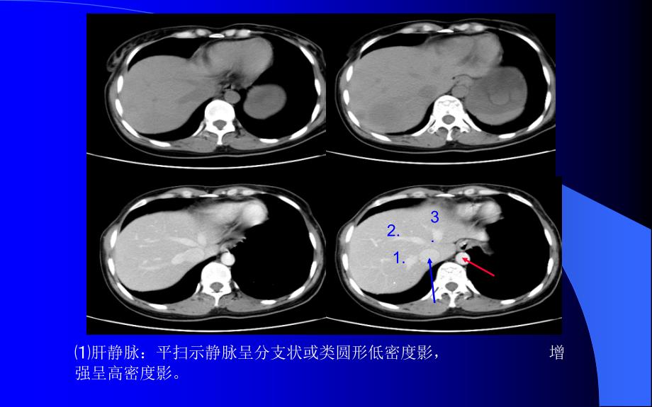 腹部CT解剖及诊断(速成)(PPT108页)_第4页