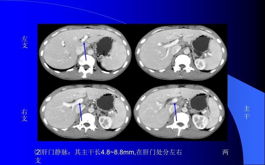 腹部CT解剖及诊断(速成)(PPT108页)_第5页